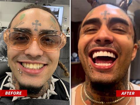 Lil Pump Gets $25,000 Mouth Makeover with New Teeth