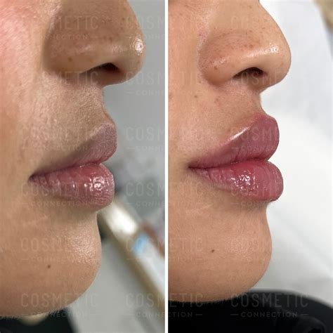 understanding ml lip filler impact cosmetic connection