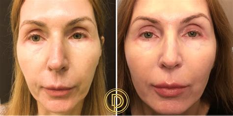 sculptra dallas sculptra filler dallas dallas dermatology partners