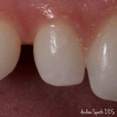 single front tooth general cosmetic dentist  newport beach ca