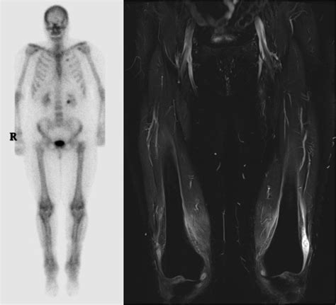 Hypertrophic Pulmonary Osteoarthropathy -Anterior Bone Scan and Coronal ...