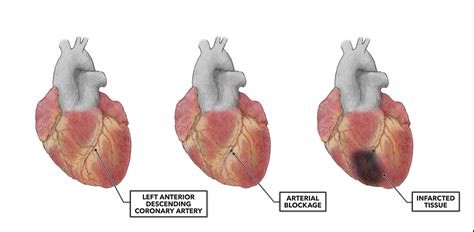 Myocardial Infarction Photo