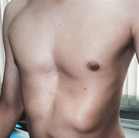 Pectus Excavatum – pectus