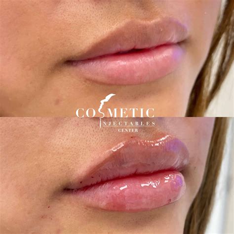 Lip Filler: Cost, Benefits, Side Effects, Reviews | Sherman Oaks
