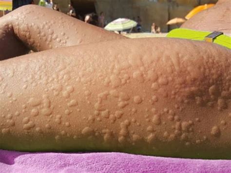 Alergia A Suor Sintomas - Alergia al Sudor: Síntomas, Causas y Estrategias de Manejo