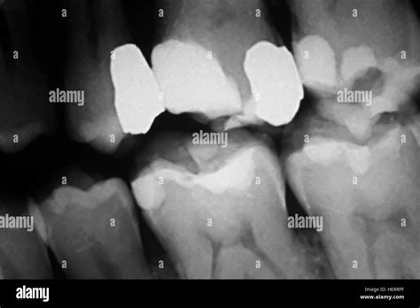 Tooth with filling dental x-ray close-up image showing teeth roots, gum ...