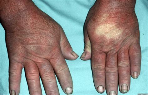 raynaud disease treatment vitamins  effective home remedies