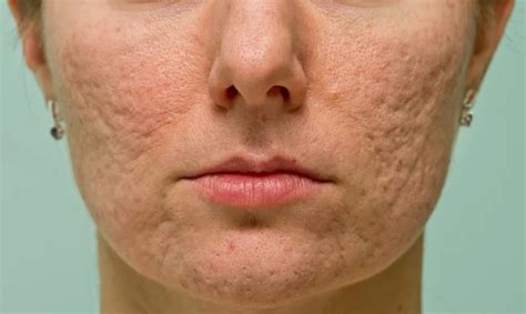 Achieve Clear Skin: #1 Atrophic Acne Scars Treatment Guide