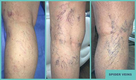 Vita K Spider Veins