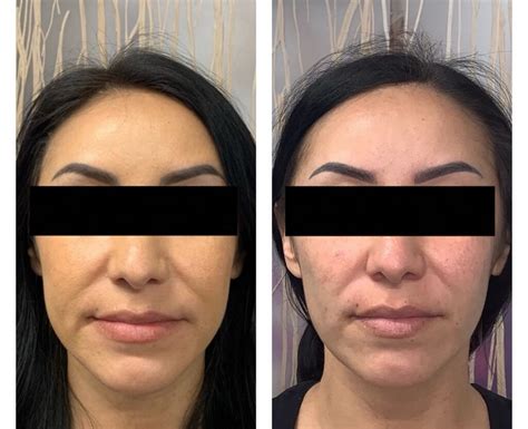 Buccal Fat Removal Archives - Sandia Cosmetic Facial Surgery