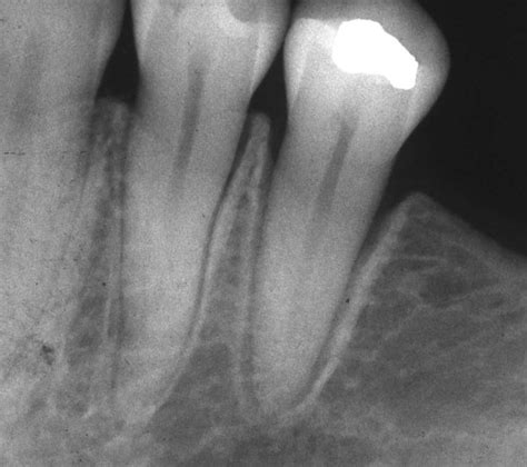 Periodontal Ligament X Ray