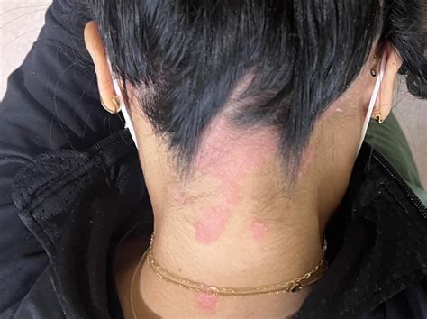 Inflamed, Itchy & Irritated : r/Psoriasis