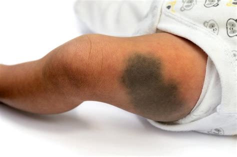 blue spot birthmark