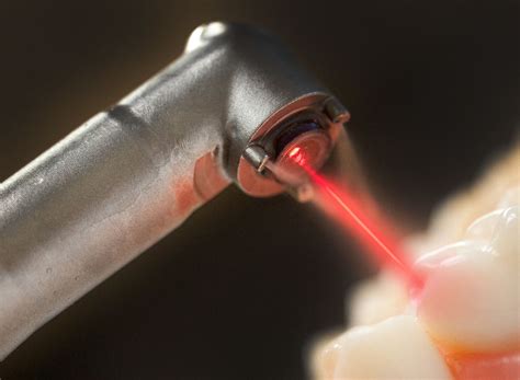 The lightwalker fotona laser uses Erbium :Yag laser energy to remove