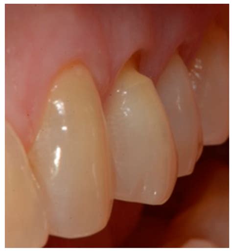 What Is Gingival Margin at Marcellus Meyers blog