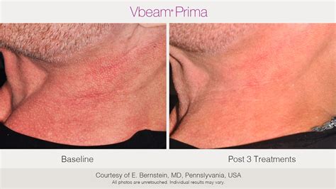 Rosacea Treatment in Princeton | Treating Rosacea in New Jersey