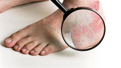 Itchy Feet - Causes and Cures Part 1 - Podiatry HQ