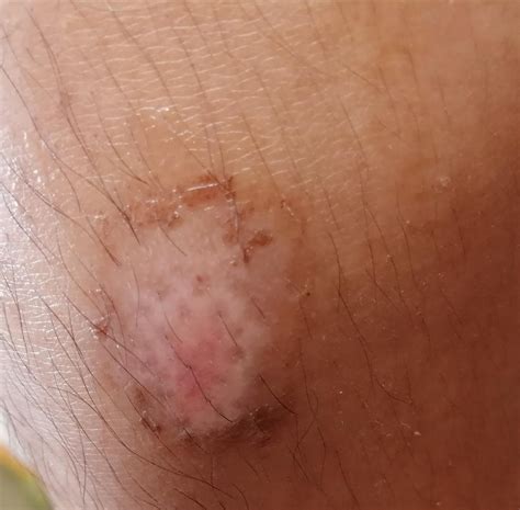 Scrapped my knee almost 3 weeks ago, it's stayed like this for a couple