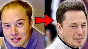 The Journey of Elon Musk Hair Transplant - Before & After