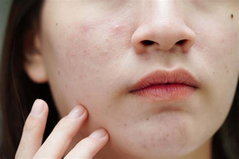 premium photo acne pimple  scar  skin face disorders
