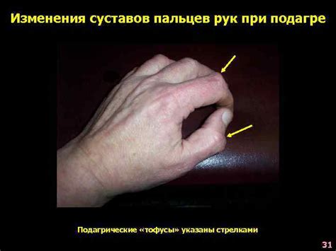 13 Нарушения обмена белков Голодание Амилоидоз 3