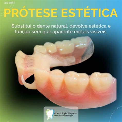 Como Se Escreve Prótese - Conheça 4 tipos de prótese - Dr. Marcelo Wayama