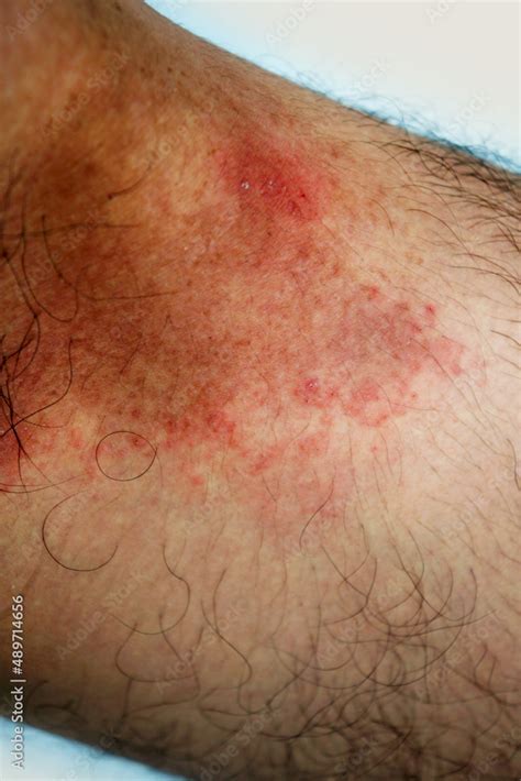 rash  mens groin area