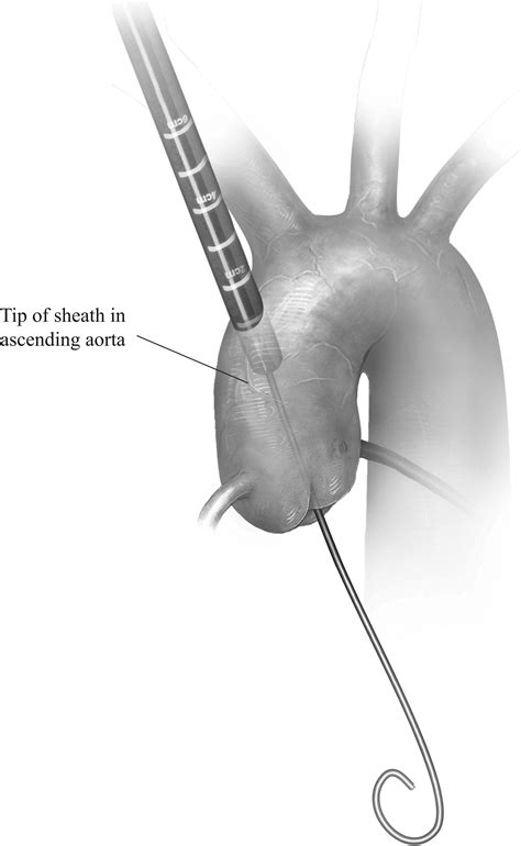 transaortic implant  transcatheter aortic valve prostheses