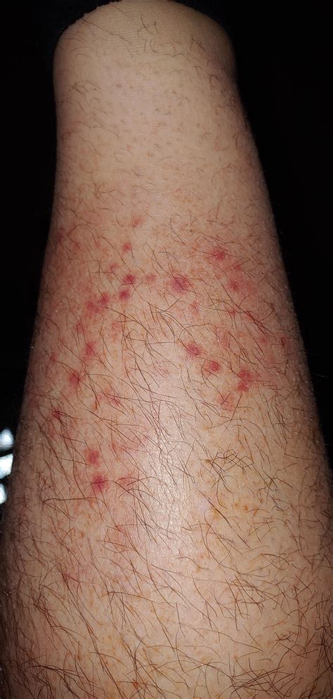 Red Dry Rash Not Itchy at Kiara Cann blog