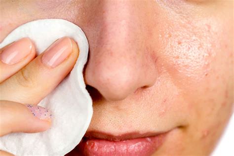 Unbelievable Blackhead Removal 2024: Get Rid Of Blackheads In 24 Hours? Image 16
