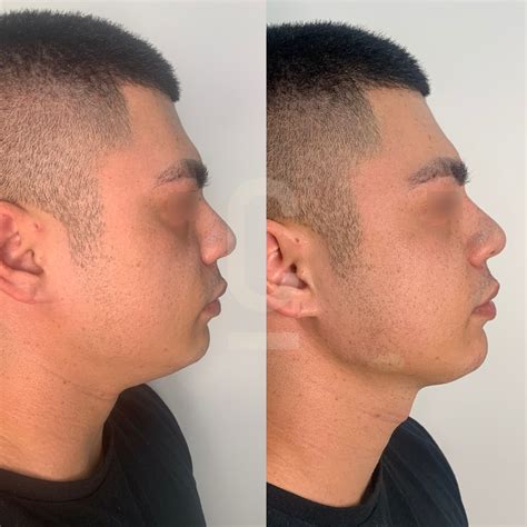 Jaw Fillers for Masculine Jawlines - Cosmetic Connection 