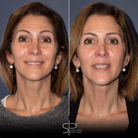 leninismo cómodo histórico tratamiento con botox para el rostro paquete ...
