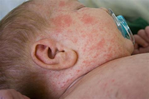 Bolinhas Vermelhas No Pescoço Do Bebê - Manchas vermelhas no bebê: o que pode ser e como tratar - Tua Saúde