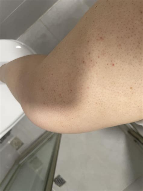 rash/allergic reaction? : r/DermatologyQuestions