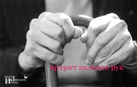 Артрит пальцев рук. Симптомы и лечение
