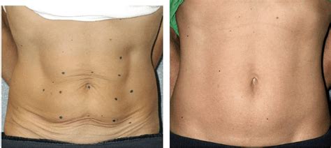 Antes E Depois Carboxiterapia - Carboxiterapia Antes e Depois – 28 Resultados Sensacionais!