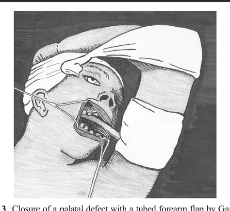 The tubed pedicle flap centennial: its concept, origin, rise and fall | Semantic Scholar