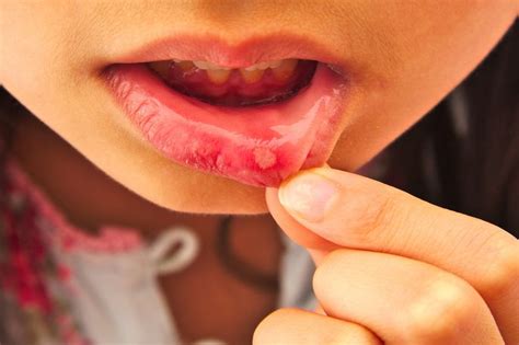 Estomatite Infantil O Que Causa - Estomatite: o que é, sintomas, causas e tratamento - Tua Saúde