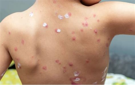 waspadai virus varicella zoster penyebab cacar air cacar api