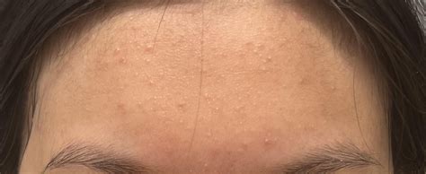 [Routine Help] Small Bumps on Forehead : r/SkincareAddiction