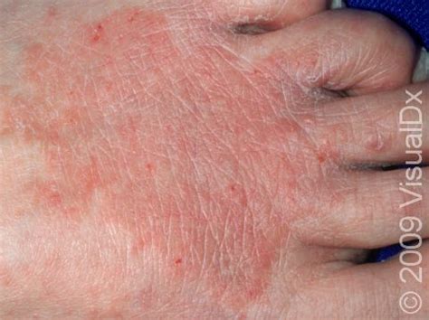 Athlete's Foot On One Foot For Years Cheap Sale | emergencydentistry.com