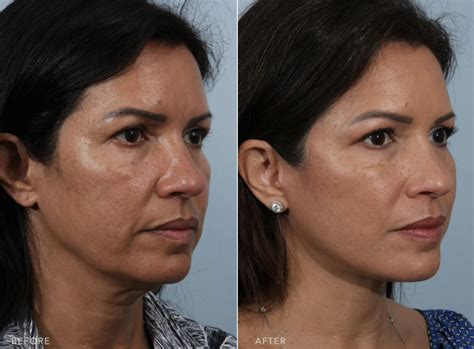 Face Lift Cost In Puerto Rico at Alice Hager blog