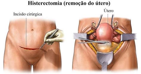 Como É Feita A Histerectomia - Histerectomia. O que é?