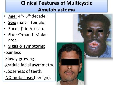 Odontogenic tumors