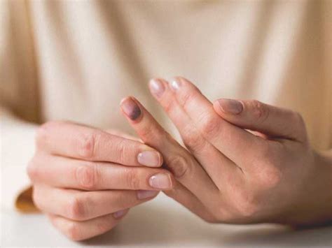 how to know if you broke your thumb