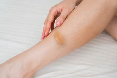 Como Tirar Roxo Da Perna - Como tirar o roxo da pele: guia completo para eliminar hematomas