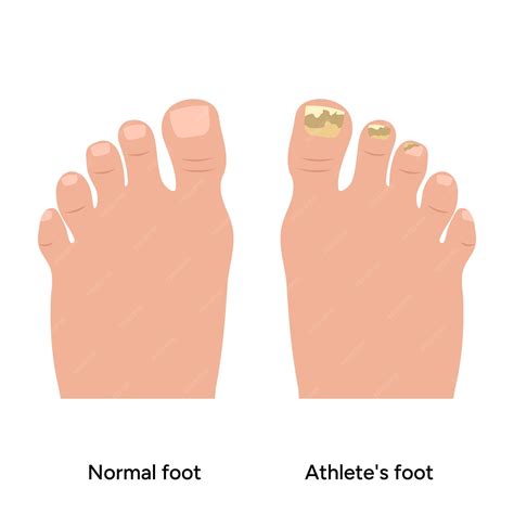 Premium Vector | Normal and Athletes foot problem nails