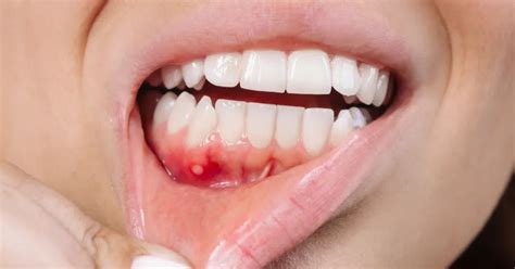 cold sores  canker sores key differences explained
