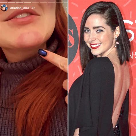 Ariadne Díaz muestra las marcas que le quedaron en el rostro tras usar