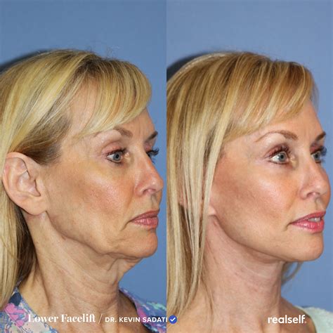 Lower Facelift: What to Expect, Results, Cost | RealSelf | Lower face ...